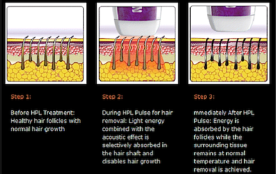 permanent hair removal