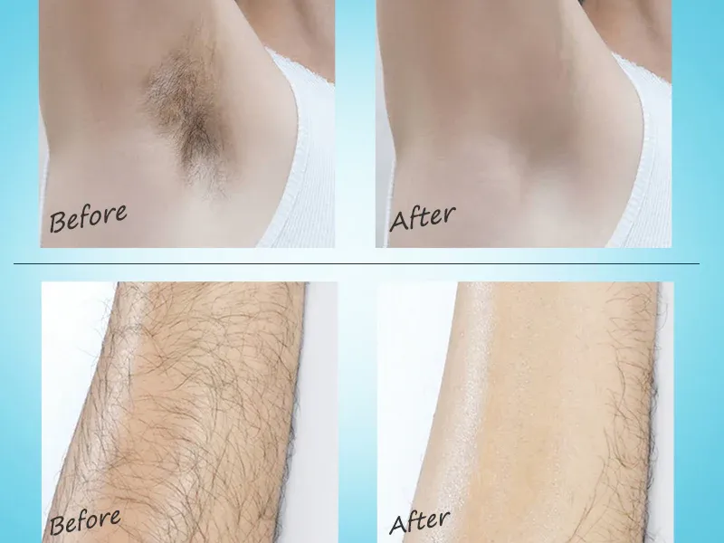 Before and after results showing effective hair removal using depilatory products