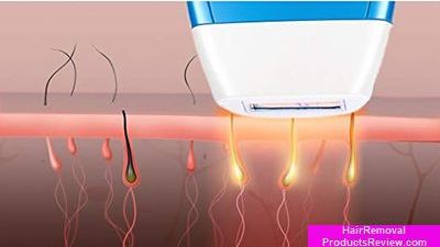IPL hair removal process
