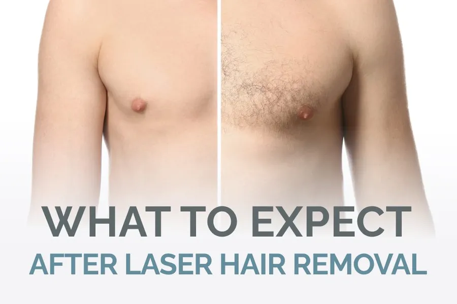 laser - what to expect