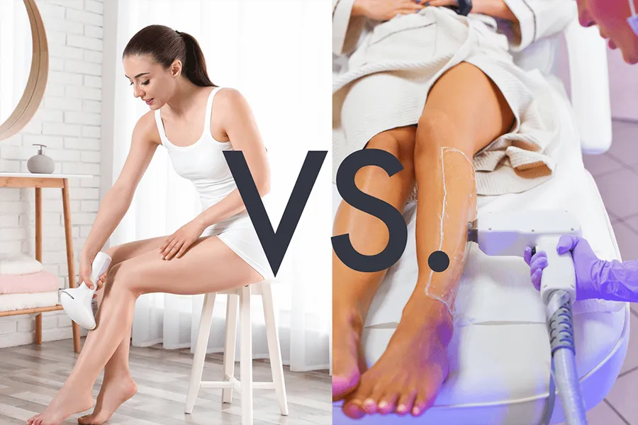 laser hair removal - home vs professional