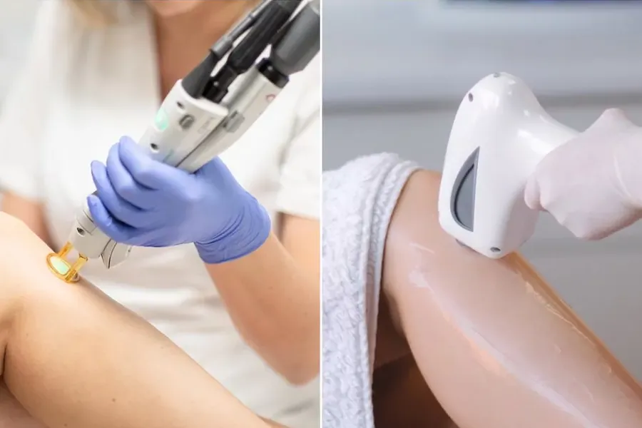 laser vs ipl
